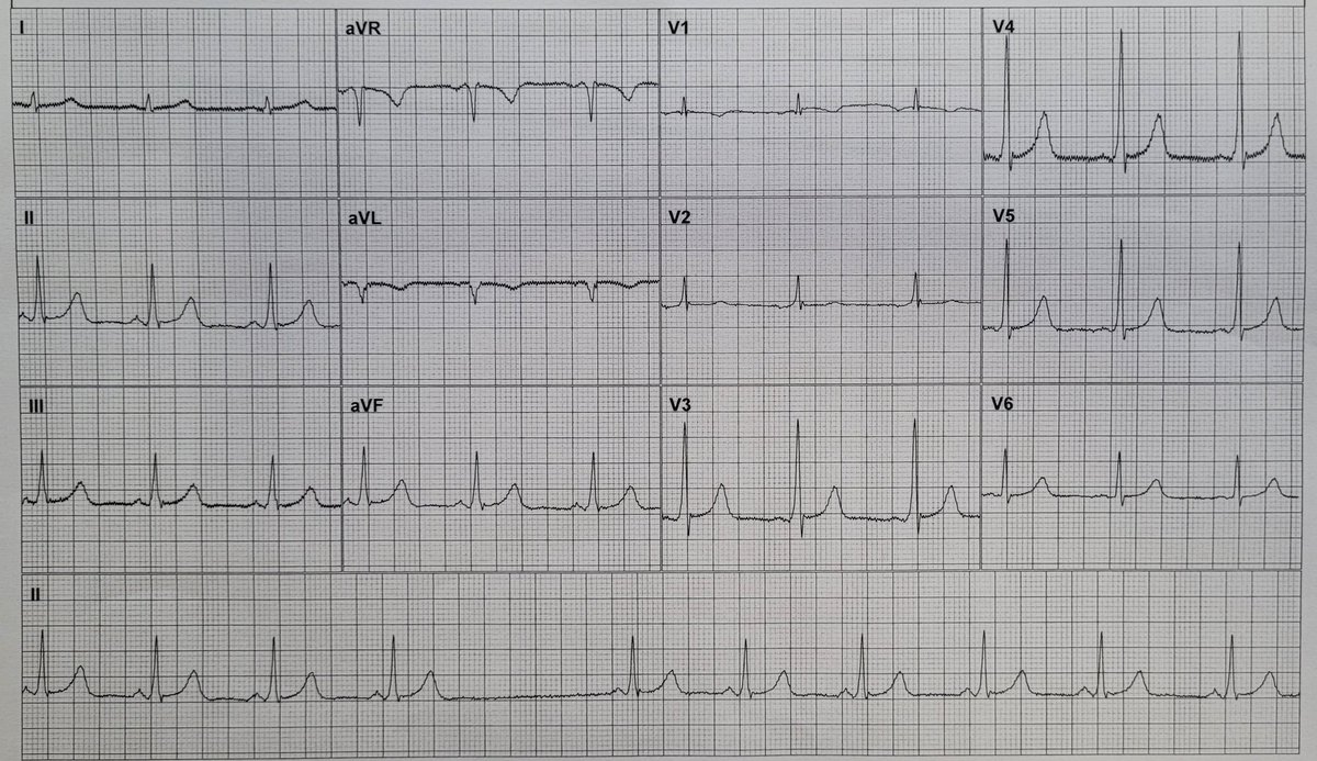 What are the two main findings present here? I have never seen these two uncommon findings, co-exist on the same ECG. #epeeps