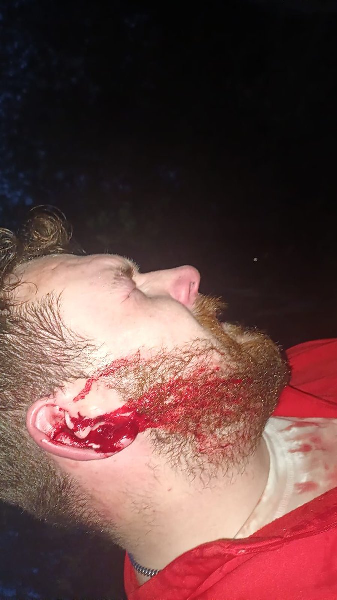 Injuries sustained by National Irish community in Newtownmount Kennedy, Wicklow Ireland 🇮🇪  tonight.

This 'Garda' is a private army working for Ireland.gov Leo Varadkar CEO which is aligned with private army PSNI