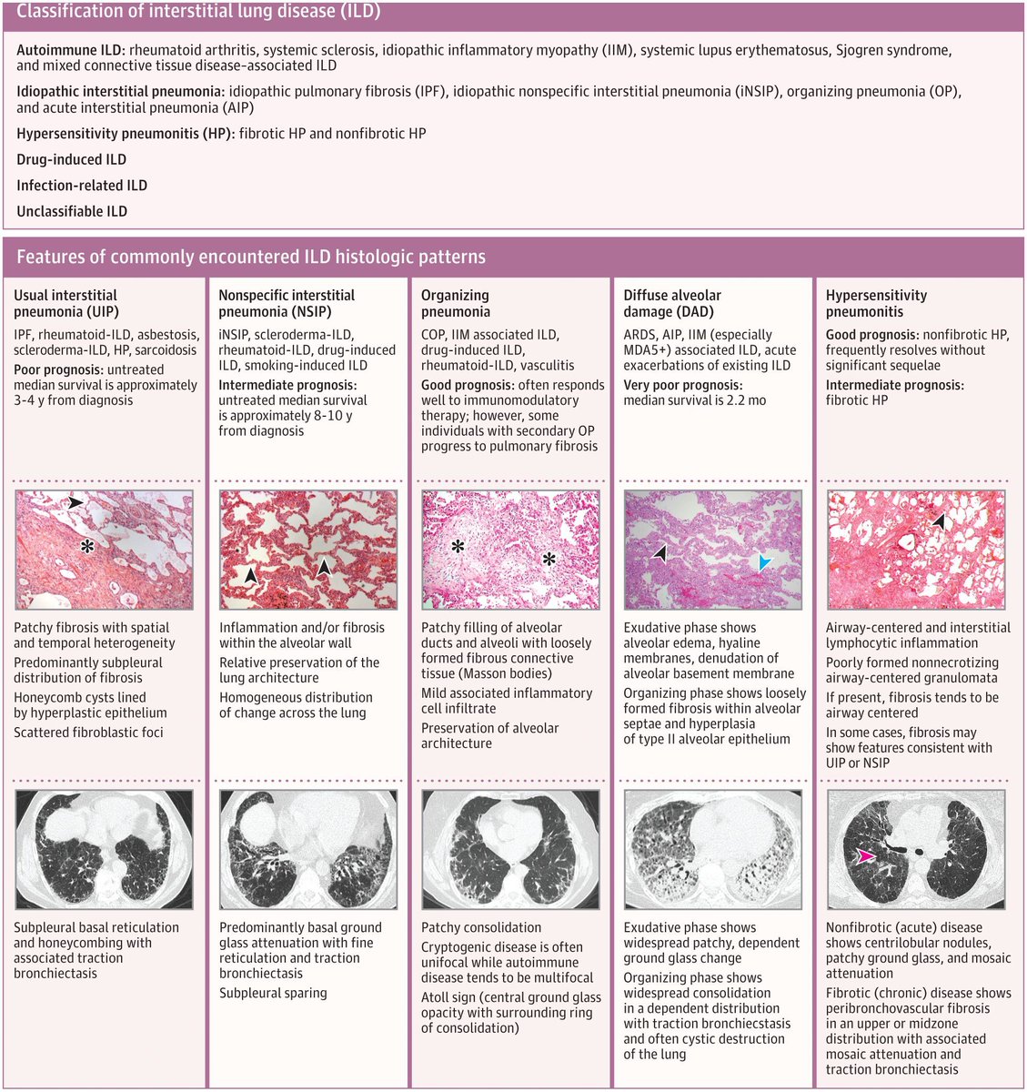 JAMA review of ILD; that affects 650,000 in USA, leading to 25,000-30,000 deaths/YR. Types reviewed. Key Symptoms: dyspnea and cough, w/ chest CT being diagnostic tool. Antifibrotic & immunomodulatory may slow disease progression. buff.ly/3Wb3gfB