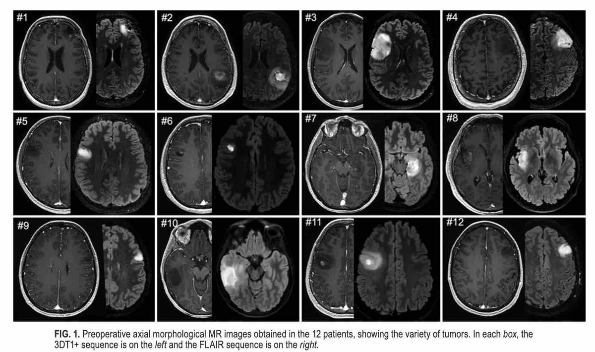 #OnlineFirst: Improvement of diffusion tensor imaging–based tractography by free-water correction in nonedematous gliomas: assessment with brain mapping. thejns.org/view/journals/….
