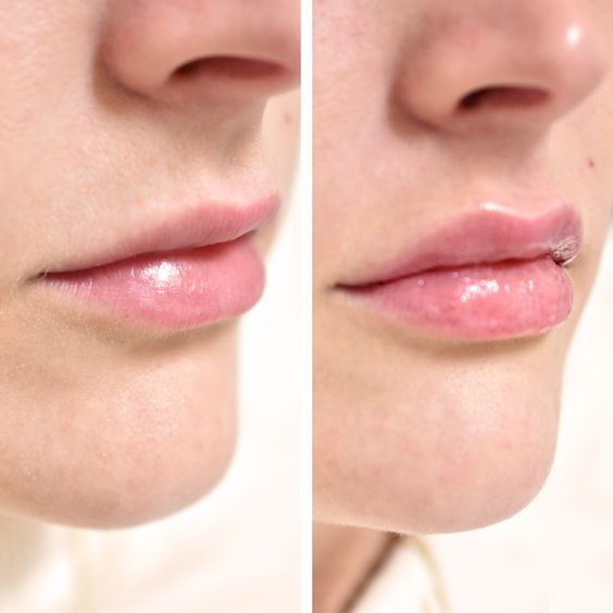 These is our 5 most liked transformation of the year - it's no wonder lips are our signature treatment!
#fille #fillasdecasandra #finanstwitter #FrenchieShore #Hungarian #HungarianGP #WarneroftheDay #Arrest