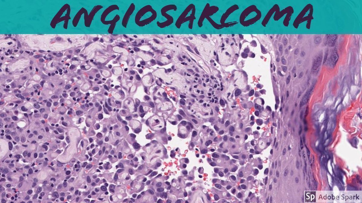 Angiosarcoma #pathology explained in <5 minutes: buff.ly/3b4NrgT. WSI digital slide via @pathpresenter: buff.ly/2G5S13g. My full vascular tumor video: buff.ly/2JRtkFX. @ mydermpath #pathologists #pathTwitter #dermpath #dermatology #dermatologia