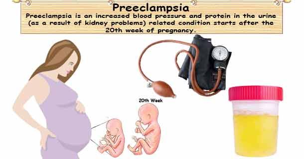 Hypertension (High Blood Pressure) Preeclampsia buff.ly/3w6VAhs #BloodPressure #Preeclampsia