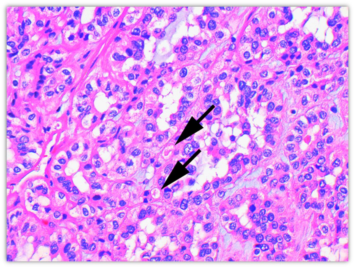 We need to be cautious when we have higher grade nuclear features, the intracytoplasmic vacuoles may be more subtle and requires careful examination! Check this study by @CaDxPath and @Kiril_T_Can pubmed.ncbi.nlm.nih.gov/25025441/ #gupath #PathTwitter