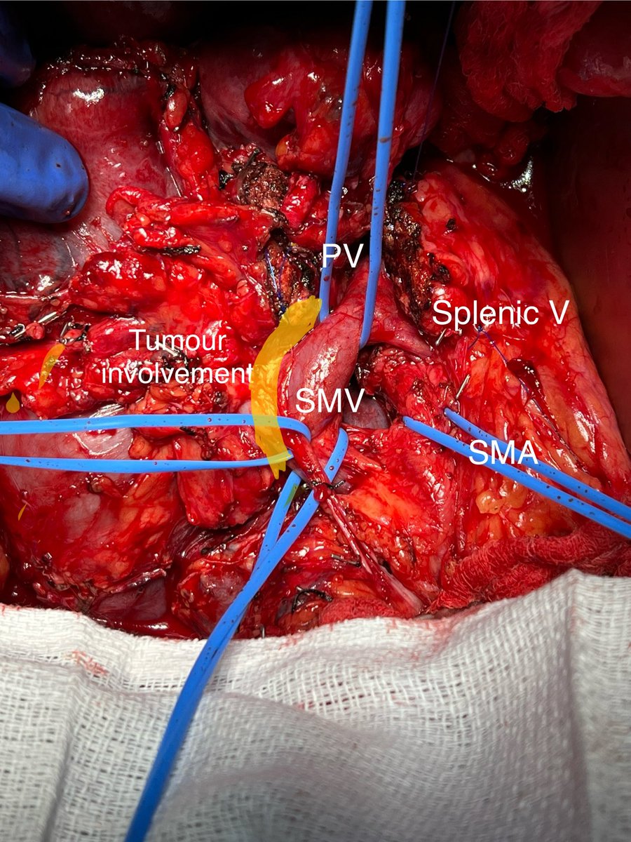 ZuhaibMir's tweet photo. Whipple with artery-first approach for tumour involving SMV, reconstructed with bovine pericardial patch

@DalHPB @hpb_so @SoMeTransplant @IHPBA @CHPBAsurg @DALsurgresearch https://t.co/72oXdObmYk