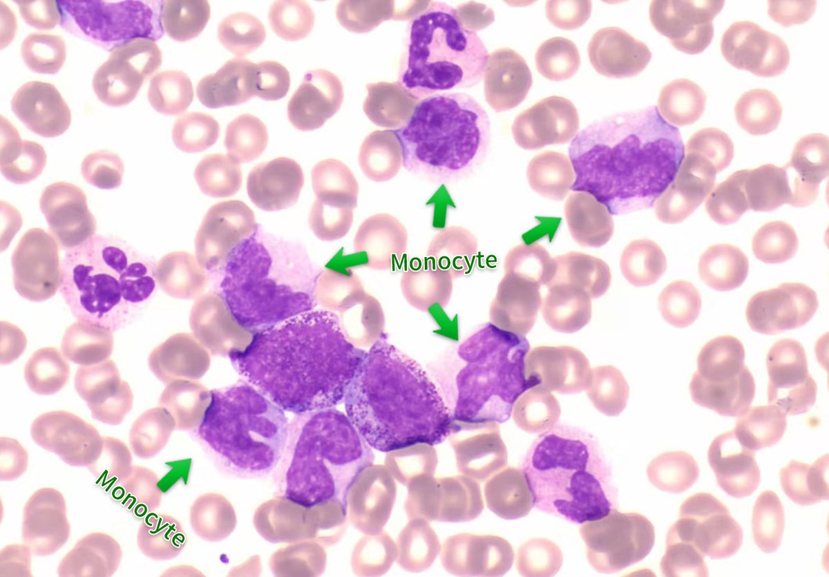 The results of peripheral blood cytomorphometric analysis of yesterday's case are as follows.
I. Cytomorphology.
1.CMML-0 (as per WHO, 2016), if as per WHO, 2022 it should be CMML-1.
2.Immunophenotyping, cytogenetics and molecular biology are recommended.
2. immunophenotyping.…