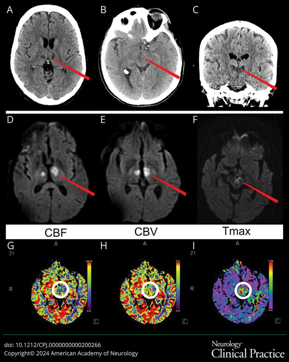 Findings of elevated blood pressure & diplopia in patients presenting w/acutely decreased level of consciousness can help identify patients with artery of Percheron infarction (AOPi). Early, accurate diagnosis of AOPi may be facilitated by emergent MRI: bit.ly/3T9urWk