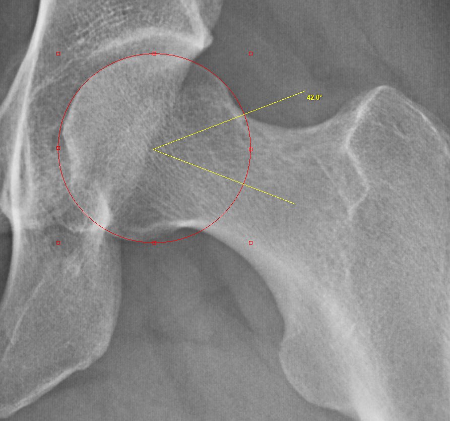 At the time of #HipArthroscopy, restoration of femoral head-neck offset is critical for treating #FAI and protecting #LabralRepair.  Our goal in removing bone is to restore a spherical femoral head and improve pain as well as impingement-free range of motion.