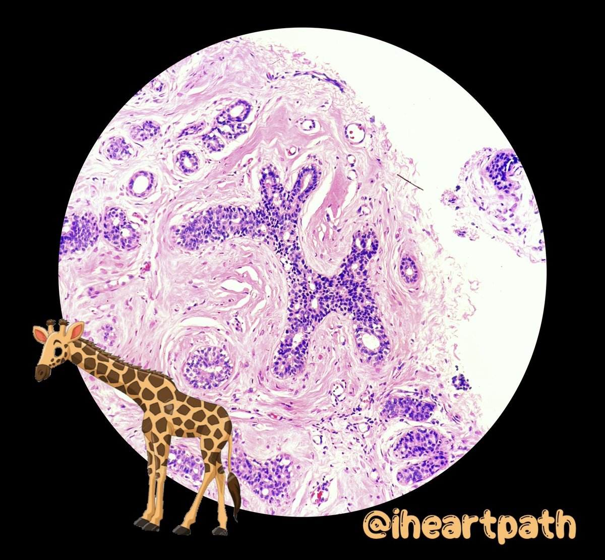 “Let your faith be bigger than your fears” #pathart picture: benign breast tissue