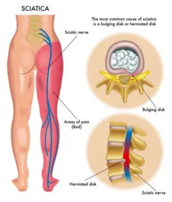 When your sciatic nerve becomes compressed or irritated, typically due to herniated discs, spinal stenosis, or muscle tightness, it manifests as sciatica — a condition characterised by sharp pain, numbness, and tingling sensations along the nerve pathway.