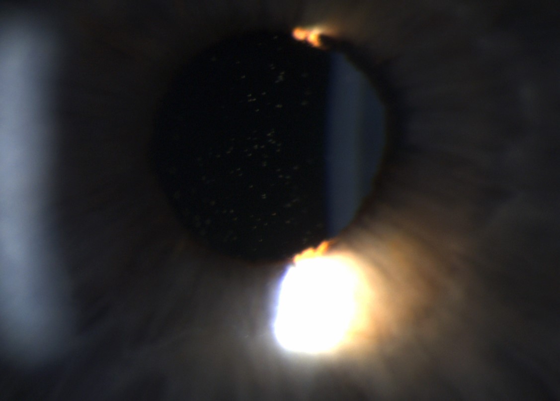 Inflammation in the anterior chamber of the eye (acute anterior uveitis). These are white cells floating in the aqueous, seen at 40x mag on the slit lamp. #OphthoTwitter #MedTwitter