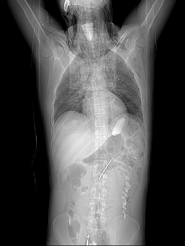 This patient presented with severe pain and oedema of the neck and chest. His family reported that he was being treated for mental disorders for the past 5 years.
- What do you see on the CT ?

➡️ Answer and Full Case: manualofmedicine.com/spot-diagnosis…

#medtwitter #foamed #foamrad