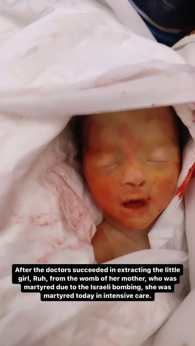 💔💔💔After the doctors succeeded in extracting the little girl, Ruth, from the womb of her mother, who was viciously killed due to the criminal ITF bombing, she was martyred today in intensive care.