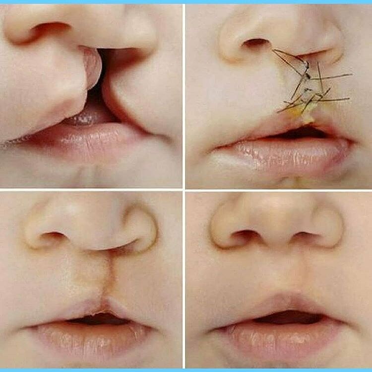 Surgical correction of congenital cleft.