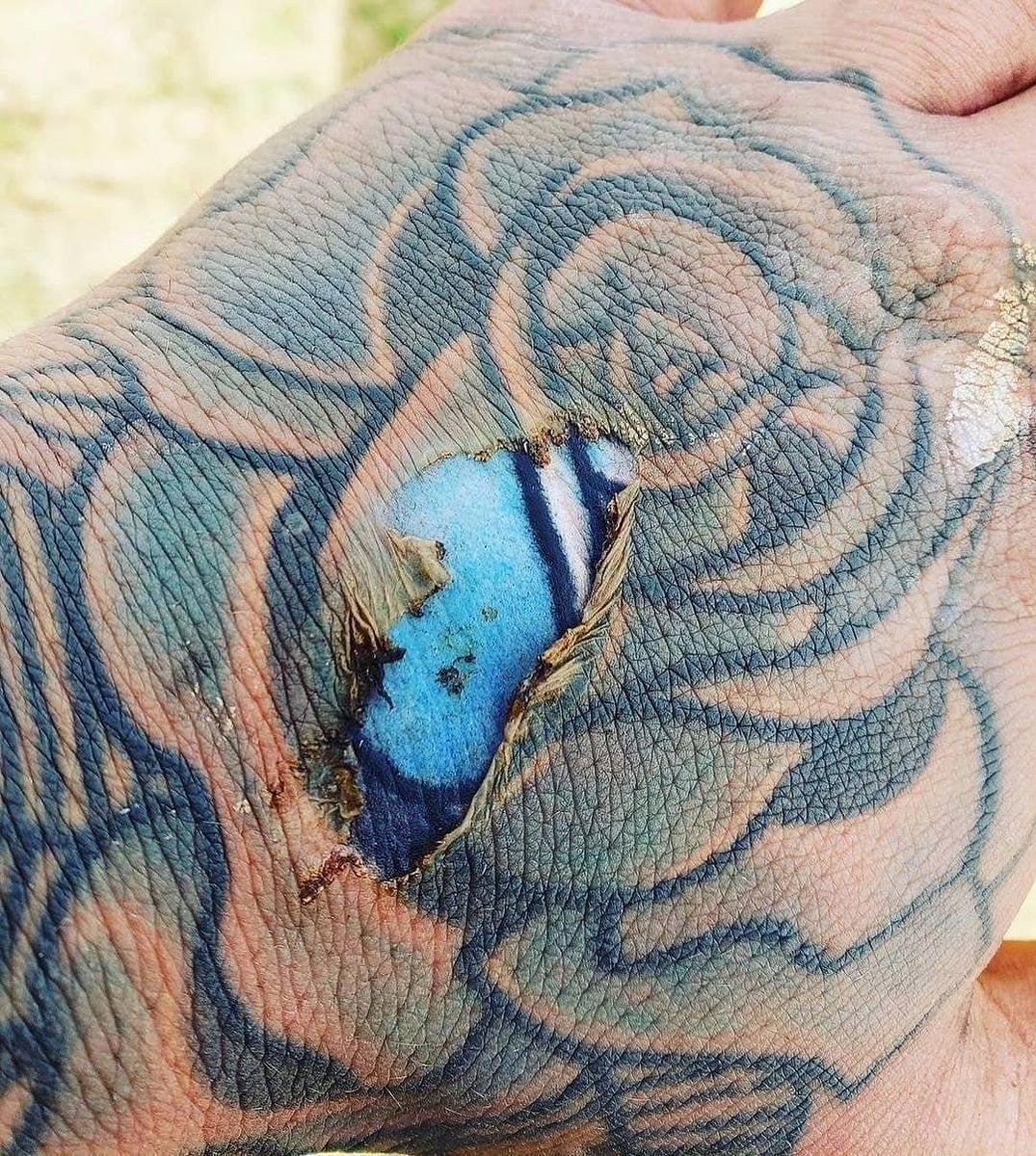 Epidermal burn of the hand exposes bright colour of tattoo ink embedded in the dermal layer of the skin.