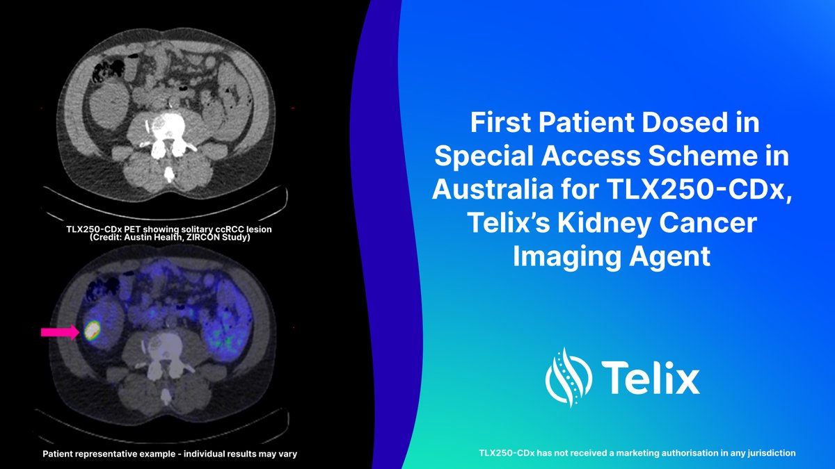 A first patient has been dosed in Australia in a Special Access Scheme for TLX250-CDx, Telix's PET imaging candidate for ccRCC. Through this program, physicians can seek named patient access while drug approval submissions are progressed worldwide. More: bit.ly/3JyRJ2r