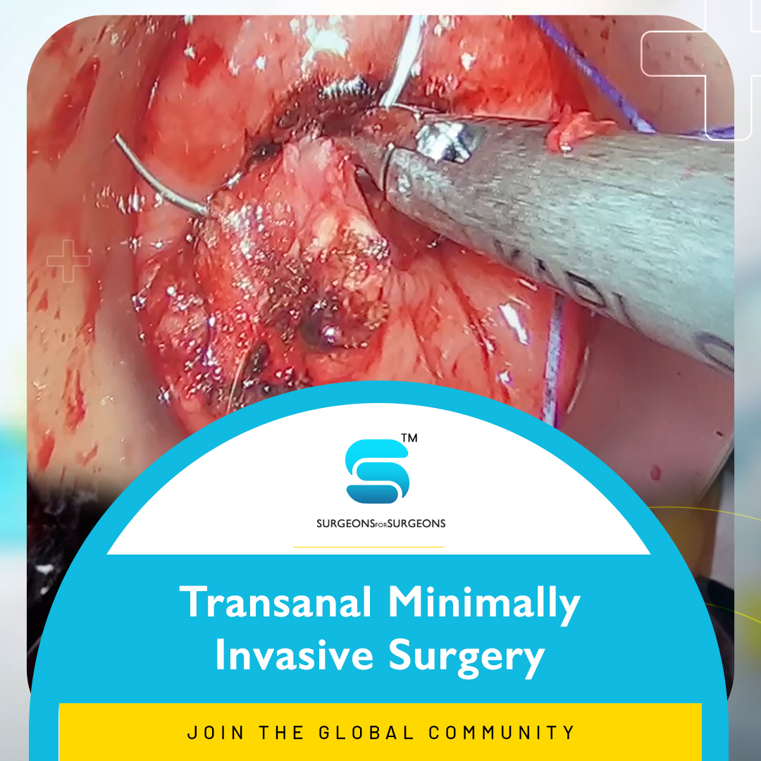 Explore more such videos on #surgicaltechniques shared by members on #SFS Join Surgeons for Surgeons, made by surgeons for surgeons. Available only to #surgeons
Install App:  
IOS: shorturl.at/afgS1
Android: shorturl.at/auCV2  

#GlobalHealth #GlobalHealthcare