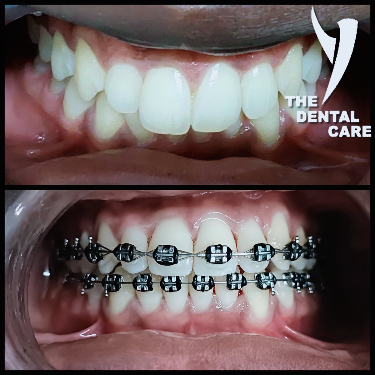 Check out the progress! Our patient has been wearing braces for 6 months and their bite is looking phenomenal!sekodental.co.za