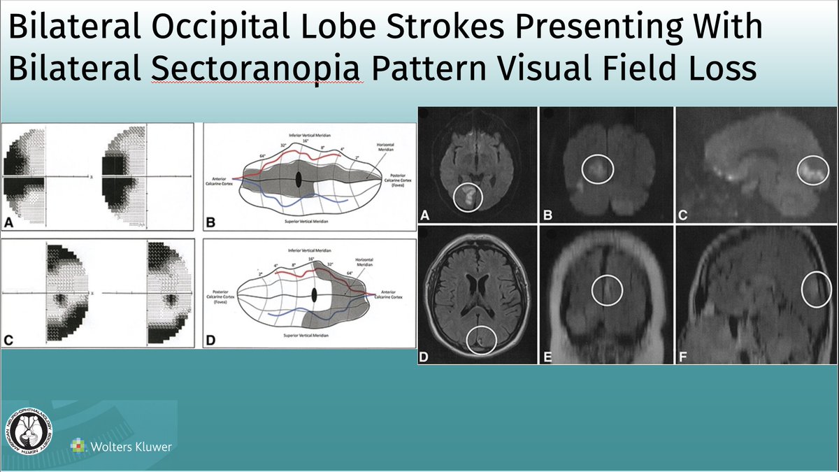 Bilateral Occipital Lobe Strokes Presenting With Bilateral Sectoranopia Pattern Visual Field Loss: Journal of Neuro-Ophthalmology
Article: bit.ly/JNO_BL_Sectora…
 #brain #eye #vision #research #NeuroTwitter #NeuroOphth #EyeTwitter #MedTwitter #Stroke @umanitoba