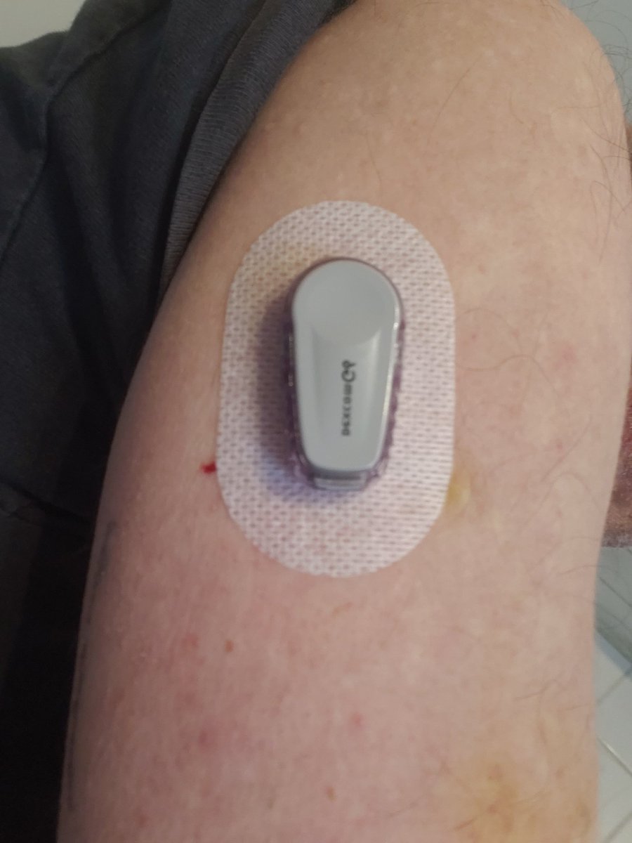 Success!

I wear my contiuous glucose sensor on the back of my upper arm.

Cleaning the skin and applying the sensor has been difficult with a dislocated shoulder.

T1D.