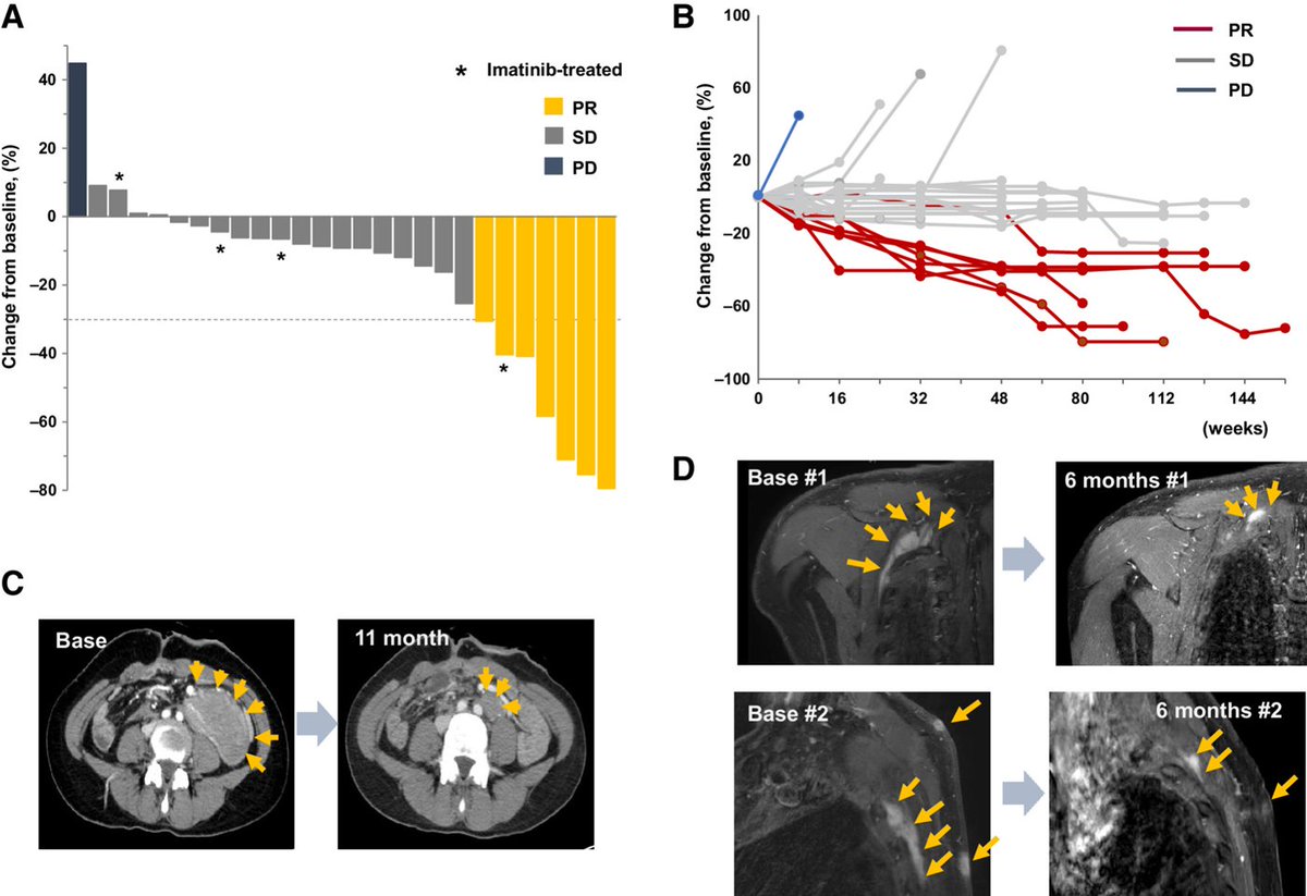 Phase 1b/2 Study: Vactosertib and imatinib combination for desmoid tumors.bit.ly/3UfsdnI