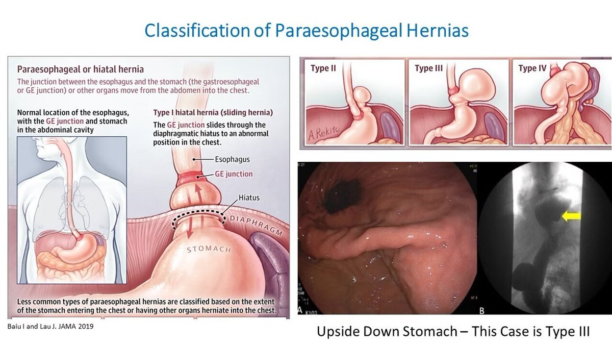 Classification of Paraesophageal or Hiatal Hernias, With An Example