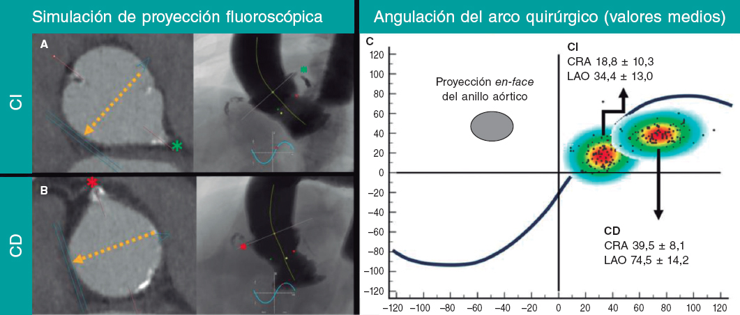 Proyecciones angiográficas basadas en TC para planificar la cateterización coronaria después de un TAVI #recintervcardiol #AheadOfPrint @AlfredoRedondoD @belcid7 @xabiira @JoseJuanatey @ramirotrillo recintervcardiol.org/es/cartas-cien…