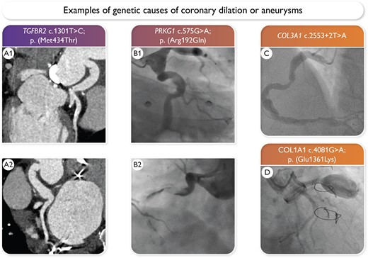 Patients with coronary aneurysms and coronary dilation: is it the time for genetic testing? #EHJ #cardiotwitter @ESC_Journals @escardio #gene #pathogenic #variants #coronary #aneurysms academic.oup.com/eurheartj/adva…