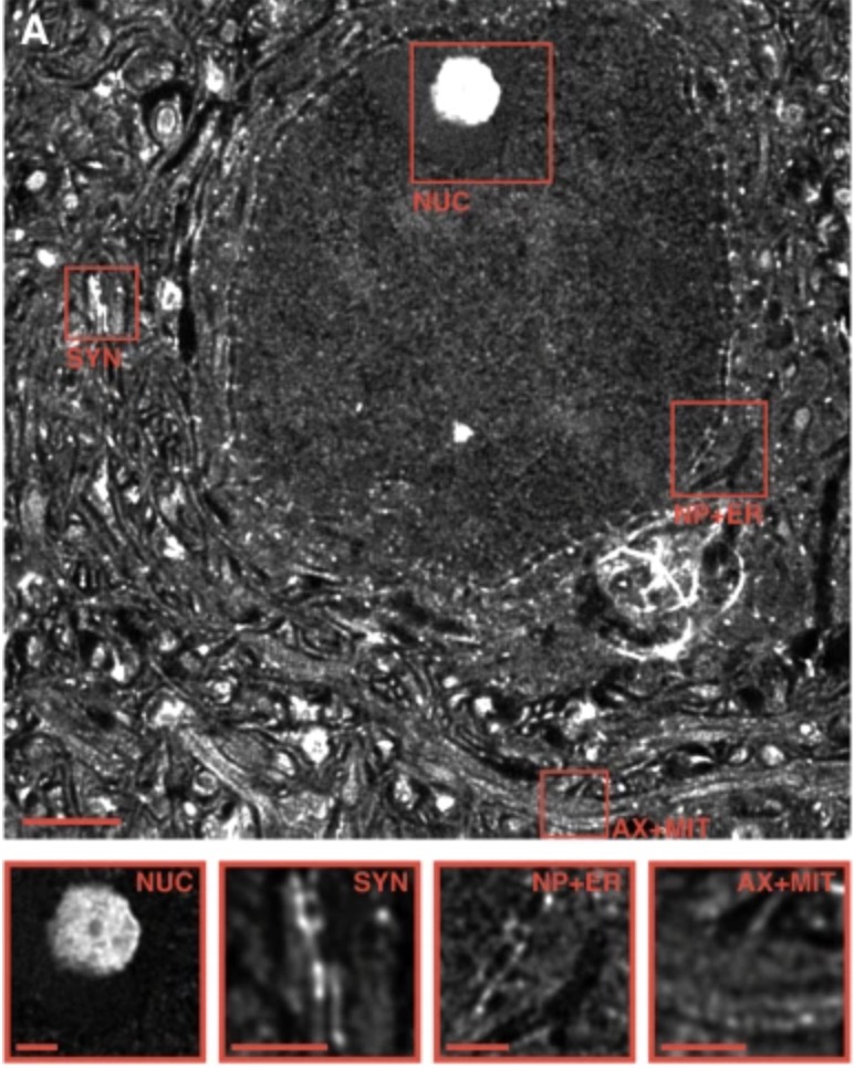 📚 Exciting News! 📚

I'm thrilled to announce our latest publication by Dr. Jan Philipp Delling.🎉 
Congratulations to JP and the entire team for their hard work and dedication! 🌟
rdcu.be/dFQbZ
#Publication #Research #Science #Academic #SHANK3