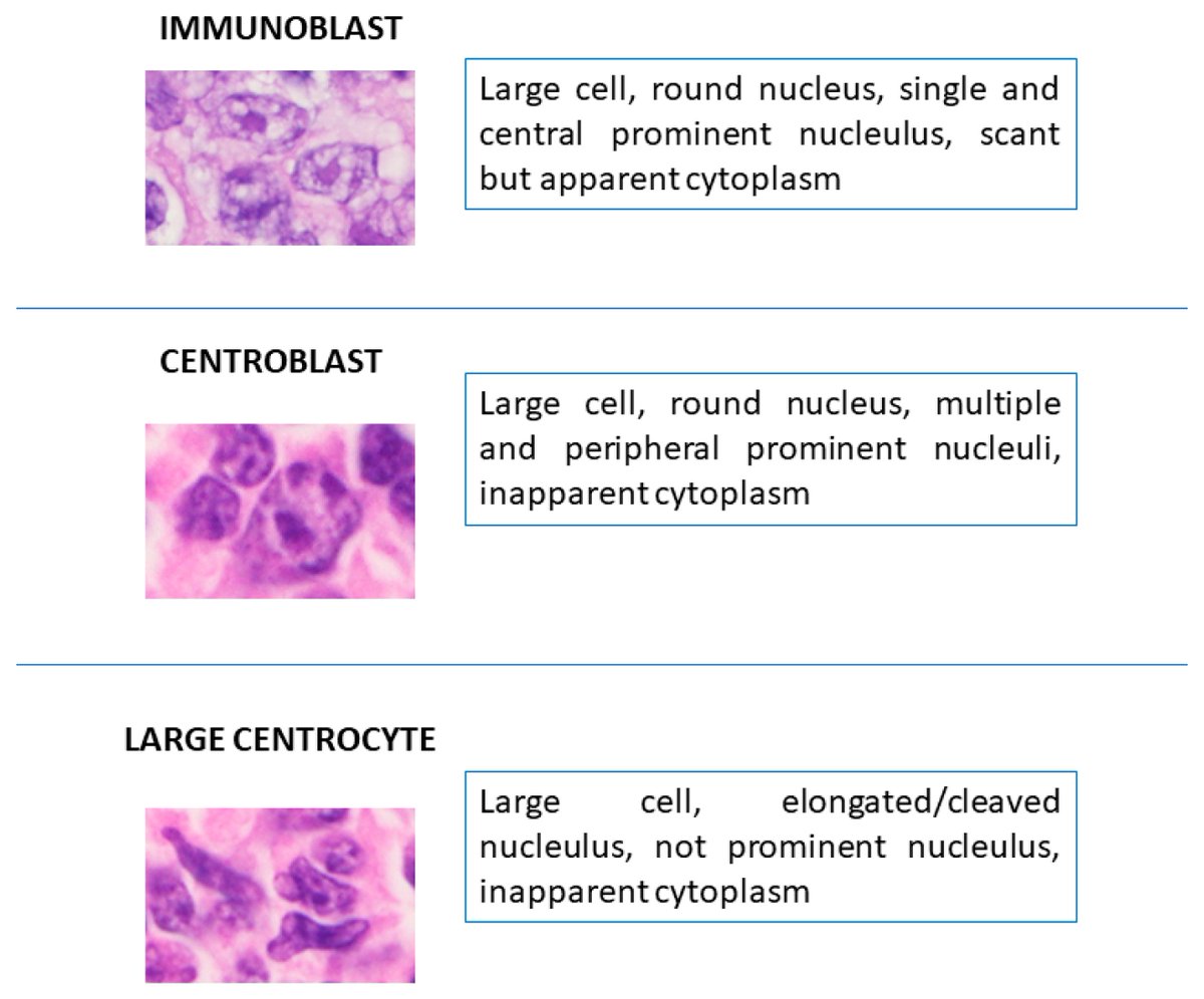 🌟#notablepaper on the Topic of B Cells 📚Primary Cutaneous B-Cell #Lymphomas with Large Cell Morphology: A Practical Review 🔗mdpi.com/2214146 👨‍🔬By Prof. Renato Franco et al @MDPIOpenAccess @MDPIBiologySubj #bcells #primarycutaneouslymphoma #folliclecenterlymphoma
