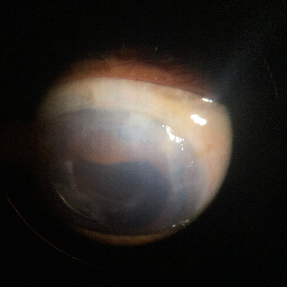 51 year old lady, one-eyed, has been under my treatment for glaucoma for 4-5 years. Was doing well, but is now showing progression in right eye.

Underwent trabeculectomy in 1985. Cataract surgery was performed 2 years back. 

Had removed synechae as much as possible, but now her…