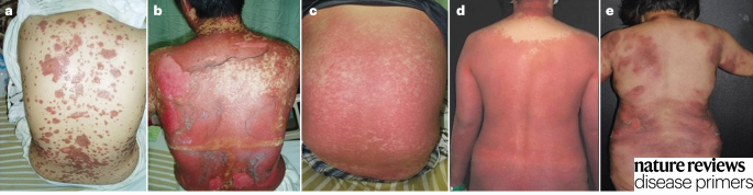 Severe cutaneous adverse reactions have a number of different clinical presentations including blisters on macules, extensive epidermal detachment, atypical targets with central blistering and areas of erythema studded with numerous minute pustules. go.nature.com/3Qkfw9Q