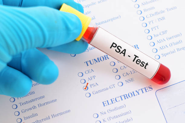 Gentlemen, take charge of your prostate health with the Prostate Specific Antigen (PSA) test at Surjen Healthcare. Early detection saves lives. 

Schedule your test today: surjen.com/lab-test-detai…

#SurjenHealthcare #ProstateHealth #PSATest #MensHealth #ProstateCancerAwareness