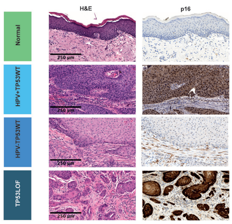 🔬EMT was correlated with the histological finding of tumor budding, which represents a scattered pattern of invasion consisting of isolated single tumor epithelial cells or tumor cells in small clusters (up to 5 cells) seen primarily at the invasive front.