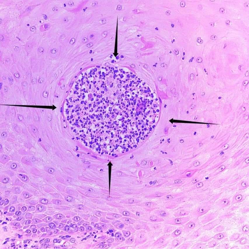 GeronimoJrLapac's tweet photo. ⚠Sometimes, the hyperplasia is so pronounced that it can lead to a misdiagnosis of SCC.
With intraepidermal abscesses, think about an infection. Make deep cuts if necessary. Here, the organisms were apparent—chromomycosis!
#pathplus #pathology #pathologist #dermpath https://t.co/51mC79lFZw
