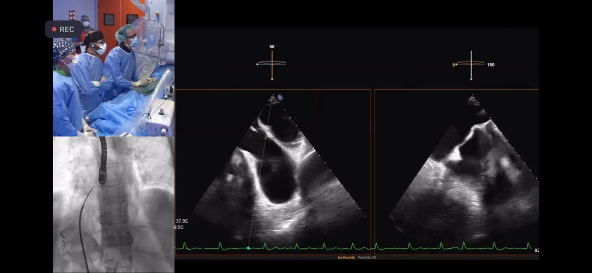Hemodinámica Son Espases (@hemosonespases) on Twitter photo Ahora un caso de orejuela en vivo!!!
Paciente con plaquetopenia severa, FA y MCH! 😱🫀
Gracias a <a href="/luisnombela/">Luis Nombela-Franco</a> y al gran @raul_rasesjd !!
Impresionante 🤩
<a href="/secardiologia/">Soc Esp Cardiología</a> <a href="/shci_sec/">ACI-SEC: Hemodinamica</a> <a href="/AbbottNews/">Abbott</a>
<a href="/SonEspases/">HU Son Espases</a> <a href="/CAR_SonEspases/">Cardio Son Espases</a> <a href="/ImagenCardiaca/">SEIC - Sociedad Española de Imagen Cardíaca</a> <a href="/CardioRed1/">CardioRed 1</a> Ahora un caso de orejuela en vivo!!!
Paciente con plaquetopenia severa, FA y MCH! 😱🫀
Gracias a <a href="/luisnombela/">Luis Nombela-Franco</a> y al gran @raul_rasesjd !!
Impresionante 🤩
<a href="/secardiologia/">Soc Esp Cardiología</a> <a href="/shci_sec/">ACI-SEC: Hemodinamica</a> <a href="/AbbottNews/">Abbott</a>
<a href="/SonEspases/">HU Son Espases</a> <a href="/CAR_SonEspases/">Cardio Son Espases</a> <a href="/ImagenCardiaca/">SEIC - Sociedad Española de Imagen Cardíaca</a> <a href="/CardioRed1/">CardioRed 1</a>