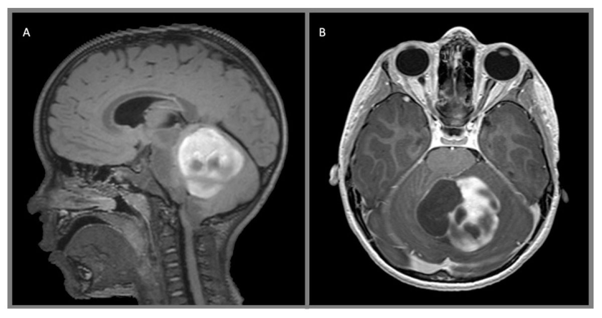 What is your diagnosis?

@AANSNeuro @The_SBNS @neurosurgatlas @TheJNS @neurosurgery @AOSpine 
#MedTwitter #MedEd #Neurosurgery #Brain #Spine