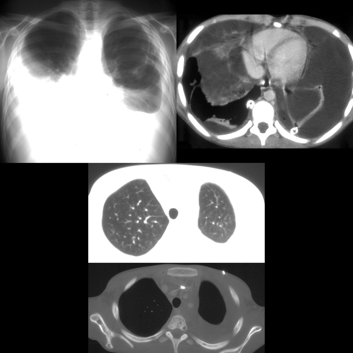 School ager with shortness of breath

CXR PA(above left) shows large bilateral pleural effusions. CT with contrast(above right) shows pleural effusions to be septated.

#FOAMed #MedEd #FOAMPed #FOAMRad #PedsRad #RadEd #RadRes #radiology #PedsPulm