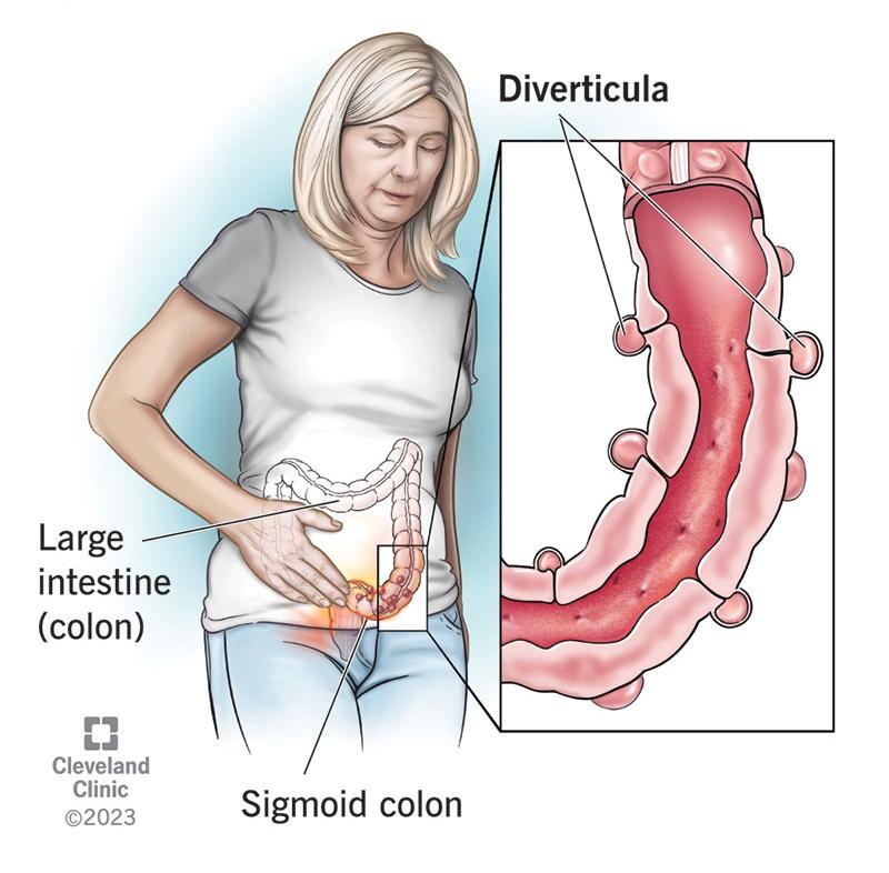 Question/23
#Saint's #triad is presence of gallstones, hiatal hernia and? 
A. Di.verticulosis 
B. Pancreatitis 
C. Haemonhoids 
D. Gastro-oesophageal reflux disease

#druk
#MedX #MedEd #Medtwitter