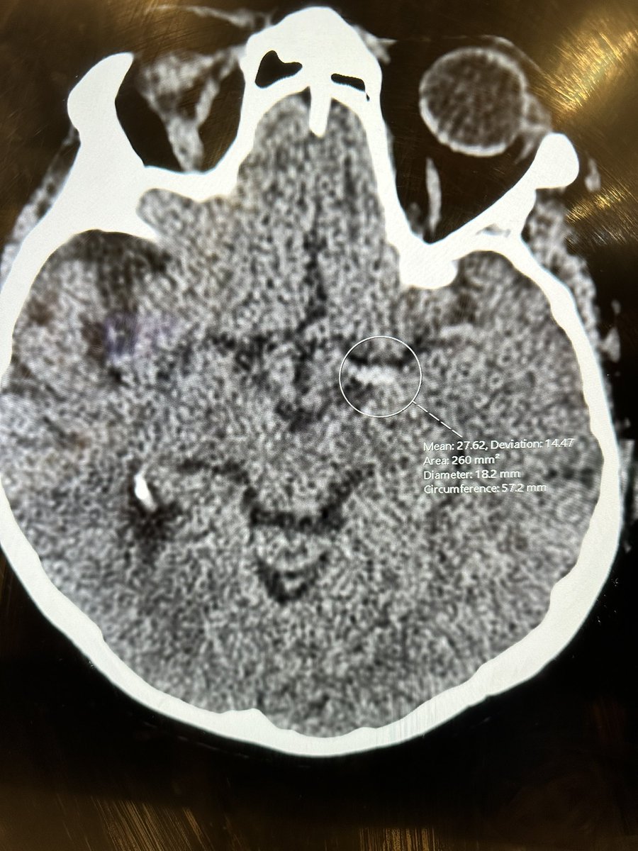 84 years with ,right sided hemiparesis. Aphasic ,GCS=11. Ct-Hyper dense left MCA ?thrombosis. Ekg - inferior wall MI . What the priority here ? Brain or heart ? Thrombolysis,PPCI  or thrombectomy ?@EM_RESUS @amalmattu @smithECGBlog @emcrit @EMBoardBombs @ALiEMteam @MedTrivias