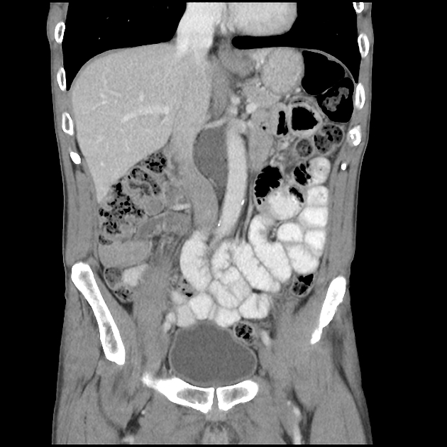 A rounded, fluid-density (~20HU) retrocrural structure is located between the aorta and IVC.Differential diagnoses for this finding included an enlarged cisterna chyli, foregut duplication cyst. from radiopaedia.org