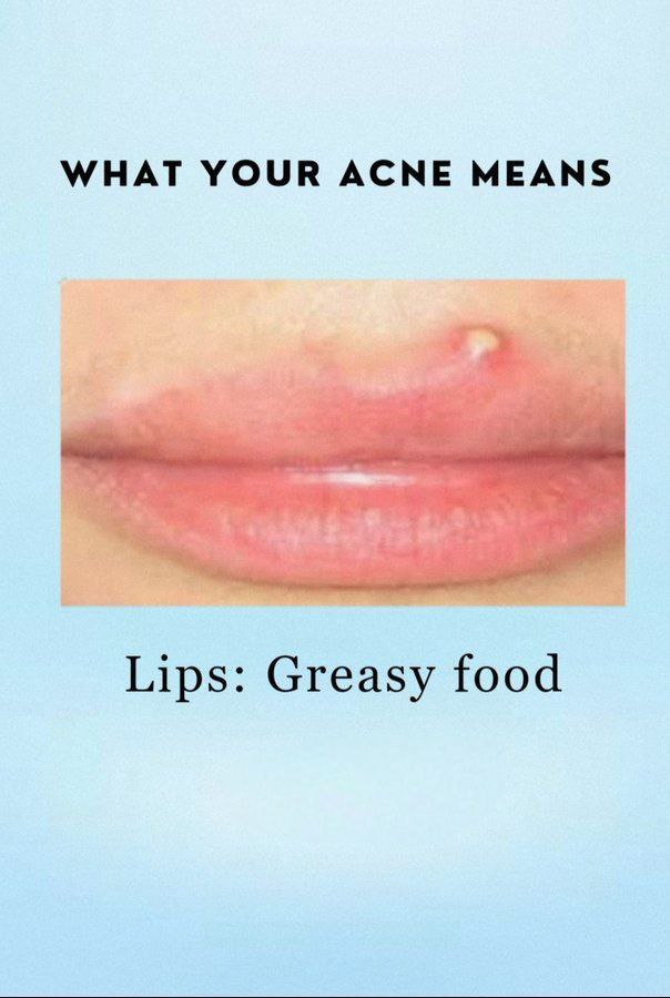 What Your Acne Means 1. Lips = Greasy food