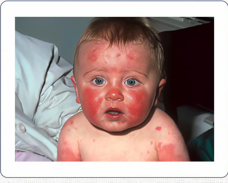 #Practice
#MCQ
Q. The causative agent of this condition is associated with which of the following disorders?

A. Treponema pallidum
B. Cytomegalovirus
C. Erythema infectiosum
D. Toxoplasma gondii

#MedEd 
#MEDHM 
#MedX 
@IhabFathiSulima