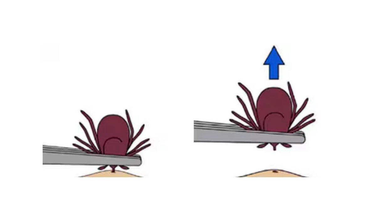 If you find a tick attached to your skin, simply remove the tick as soon as possible. There are several tick removal devices on the market, but a plain set of fine-tipped tweezers works very well.

#Guelph #GuelphPestControl #HomeInspections #Home #Mice #Raccoons #Ticks #Spring