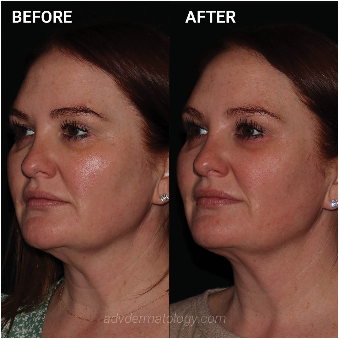 Our patient achieved noticeable results after Emface Submentum. By targeting excess fat and lax skin in the chin and neck area, it delivers noticeable contouring and tightening effects. Say hi to a firmer, more sculpted jawline and neckline! Learn more ⬇️

advdermatology.com/request-appoin…