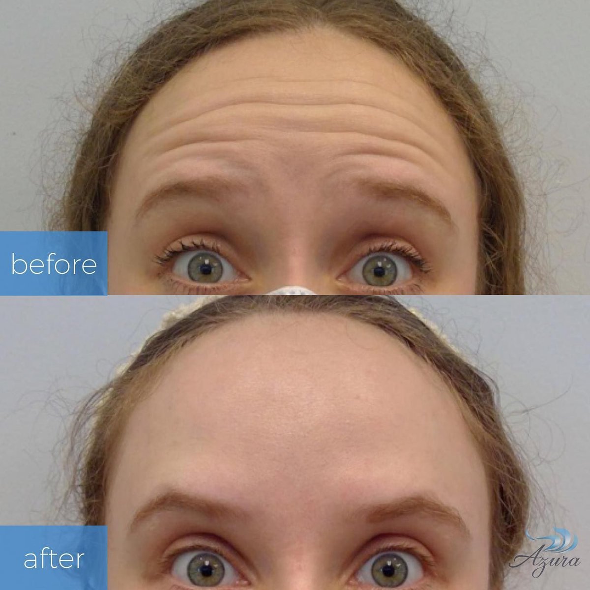 Wave goodbye to wrinkles and say hello to youthful radiance! Explore our gallery of before-and-after photos at buff.ly/3vRkiF4.

#botox #wrinkles #dysport #injectables #medspa #yourenewed #skincare #azura #medspa #cary #carync #raleigh #raleighnc