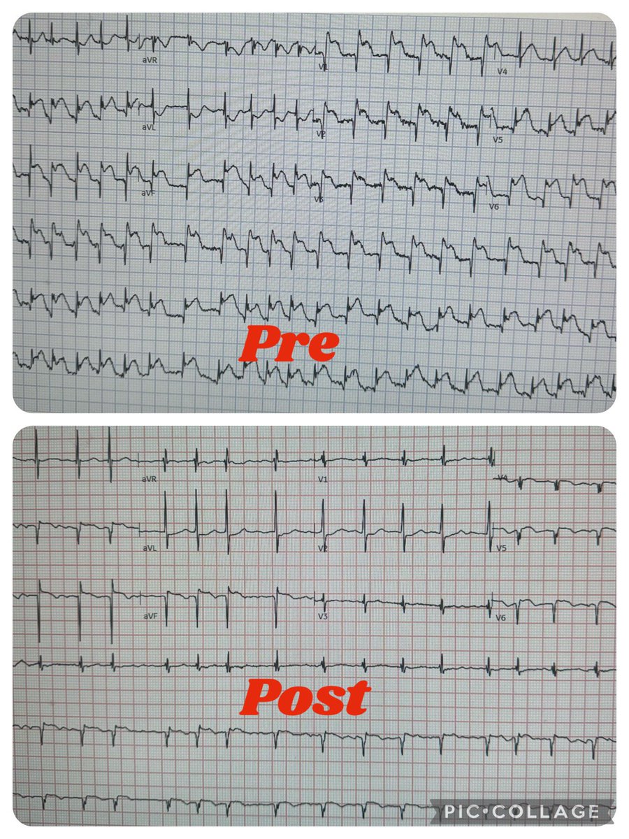 60s, 10/10 chest pain (pre), 0/10 chest pain (post), what vessel or vessels was/were intervened on? Vote 🗳️ @ACCinTouch @SCAI @EkgHacks @Eppeep @ShariqShamimMD @mirvatalasnag @mmamas1973 @Pooh_Velagapudi @agtruesdell @Almanfi_Cardio @AntoniousAttall @djc795 @DLBHATTMD…