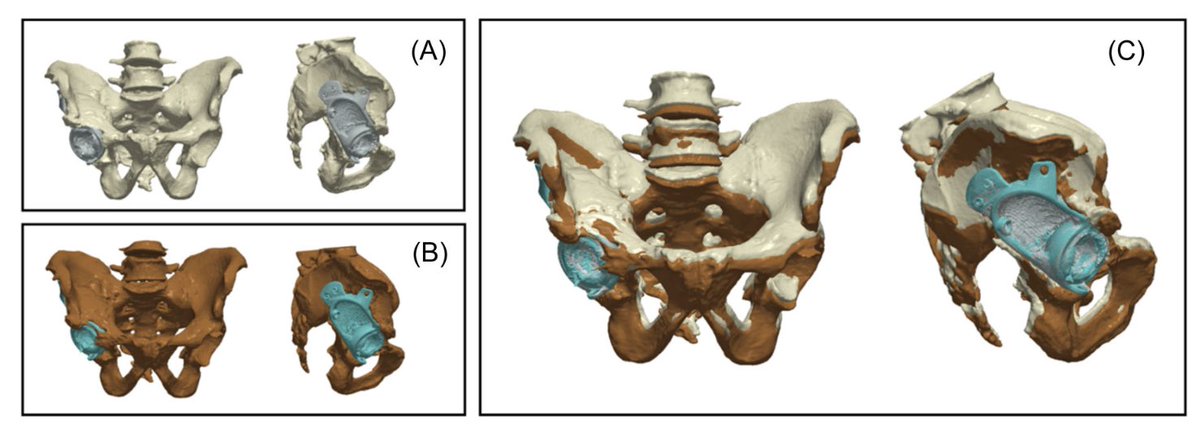 New research out of @clecliniclondon, @ucl, & @RNOHnhs highlights the dynamic bony changes that occur after acetabular reconstruction, leading to implant migration. (De Angelis et al. @JOrthopRes) Link: doi.org/10.1002/jor.25… #ORSSMC