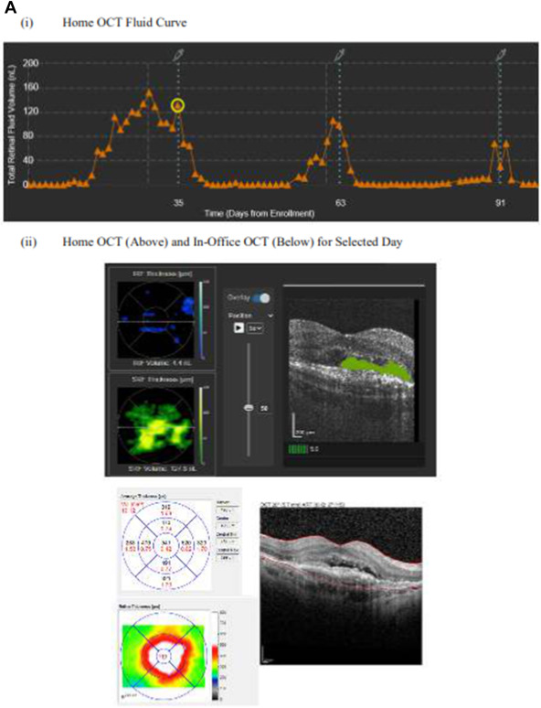 A home OCT device shows promise for monitoring patients with neovascular #AMD. #NEIfunded work from @DrcrNet @AAOjournal paper: bit.ly/3VZZqWK