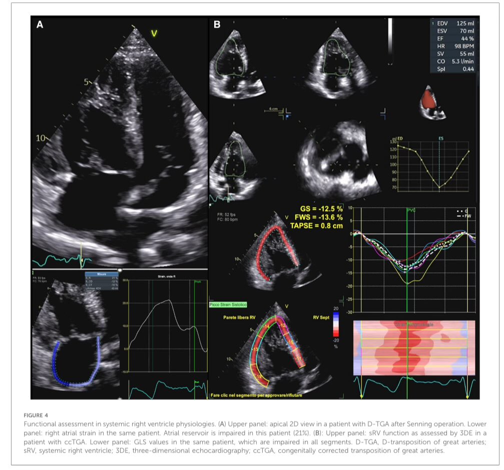 The mechanics of congenital heart disease: from a morphological trait to the functional echocardiographic evaluation dx.doing.org/doi:10.3389/fc… #CardioEd #Cardiology #cardiotuiteros #CardioTwitter #echofirst